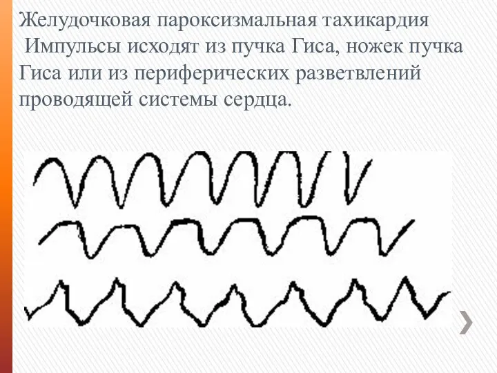 Желудочковая пароксизмальная тахикардия Импульсы исходят из пучка Гиса, ножек пучка Гиса или