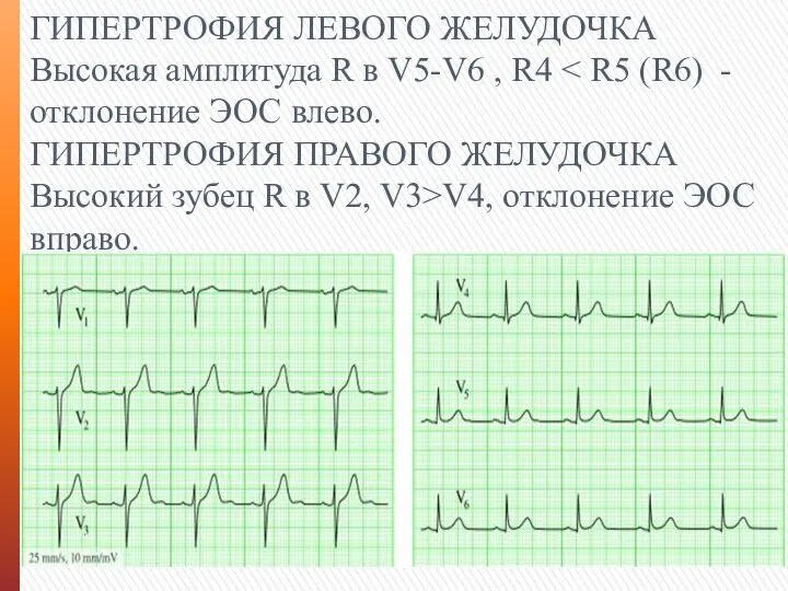 ГИПЕРТРОФИЯ ЛЕВОГО ЖЕЛУДОЧКА Высокая амплитуда R в V5-V6 , R4 ГИПЕРТРОФИЯ ПРАВОГО