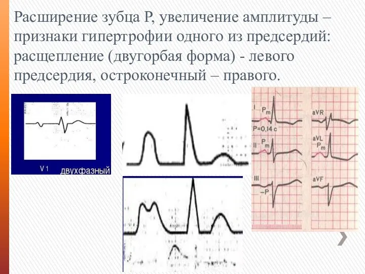 Расширение зубца Р, увеличение амплитуды – признаки гипертрофии одного из предсердий: расщепление