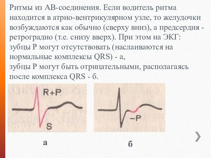 Ритмы из АВ-соединения. Если водитель ритма находится в атрио-вентрикулярном узле, то желудочки
