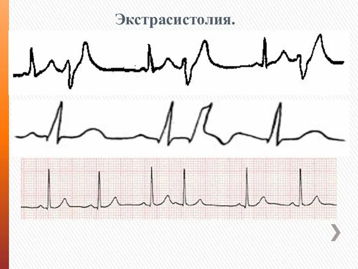 Экстрасистолия.