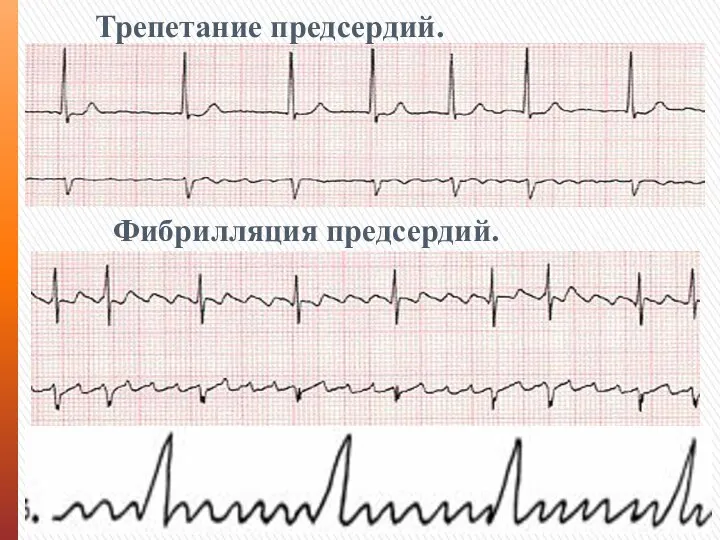 Трепетание предсердий. Фибрилляция предсердий.
