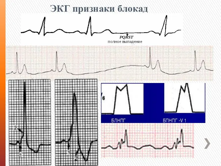 ЭКГ признаки блокад