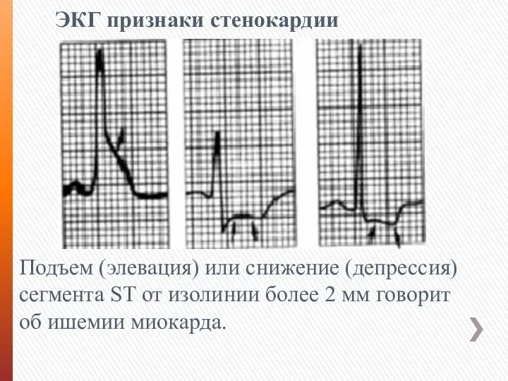 ЭКГ признаки стенокардии Подъем (элевация) или снижение (депрессия) сегмента ST от изолинии