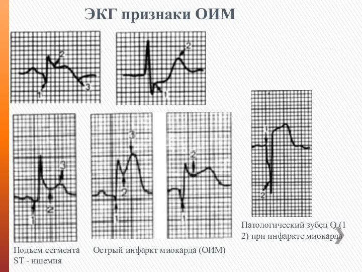 ЭКГ признаки ОИМ Подъем сегмента ST - ишемия Острый инфаркт миокарда (ОИМ)