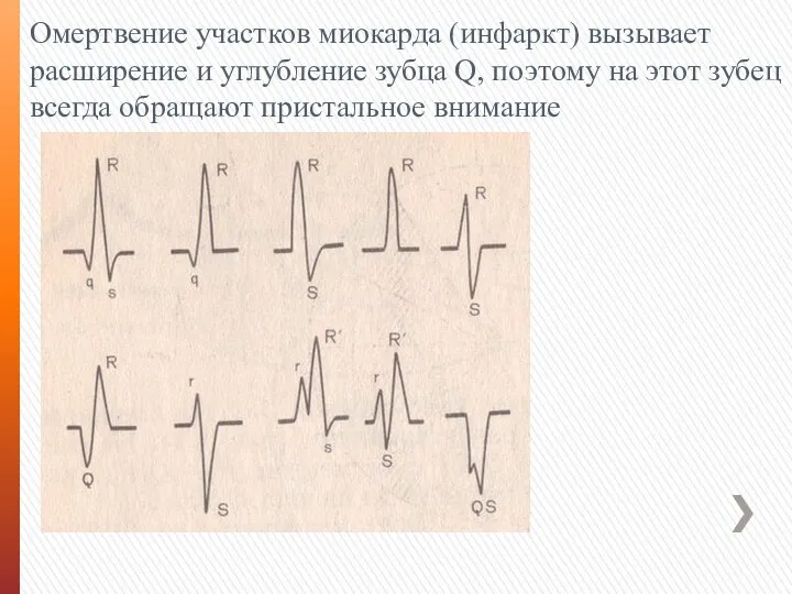 Омертвение участков миокарда (инфаркт) вызывает расширение и углубление зубца Q, поэтому на