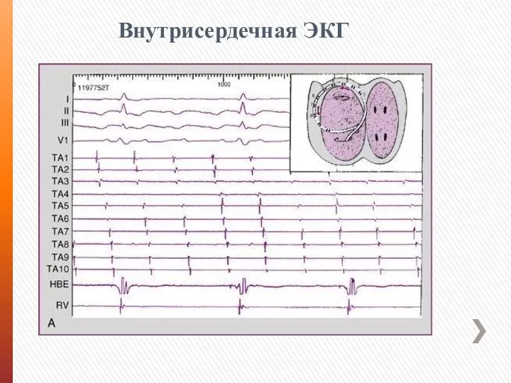 Внутрисердечная ЭКГ