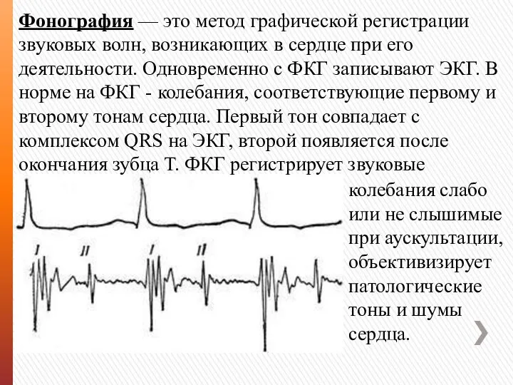 Фонография — это метод графической регистрации звуковых волн, возникающих в сердце при