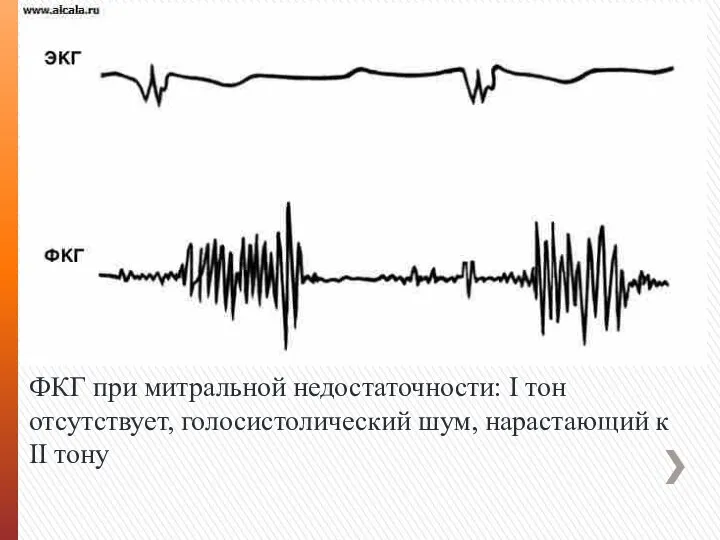 ФКГ при митральной недостаточности: I тон отсутствует, голосистолический шум, нарастающий к II тону