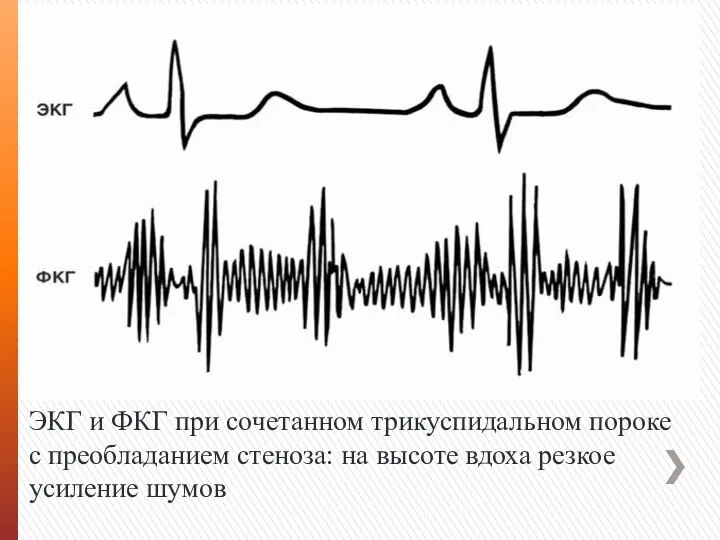 ЭКГ и ФКГ при сочетанном трикуспидальном пороке с преобладанием стеноза: на высоте вдоха резкое усиление шумов