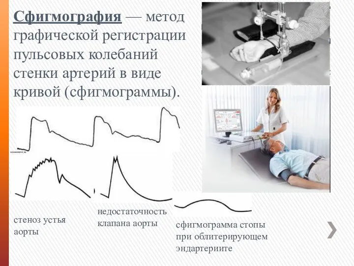 Сфигмография — метод графической регистрации пульсовых колебаний стенки артерий в виде кривой