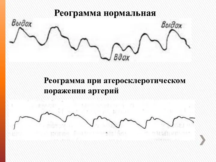 Реограмма нормальная Реограмма при атеросклеротическом поражении артерий