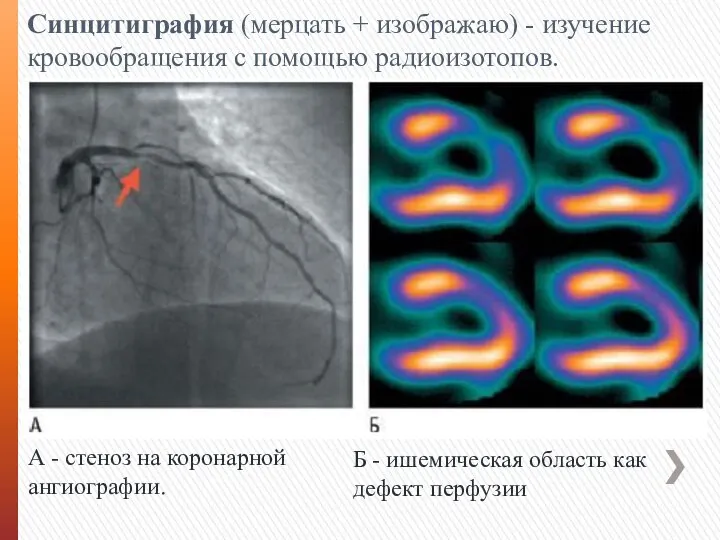 Синцитиграфия (мерцать + изображаю) - изучение кровообращения с помощью радиоизотопов. А -