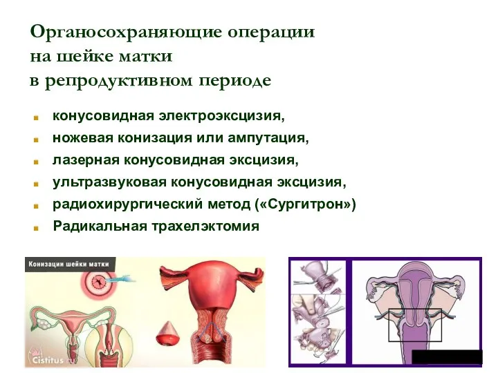 Органосохраняющие операции на шейке матки в репродуктивном периоде конусовидная электроэксцизия, ножевая конизация