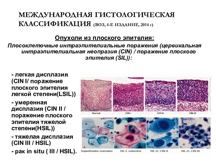 МЕЖДУНАРОДНАЯ ГИСТОЛОГИЧЕСКАЯ КЛАССИФИКАЦИЯ (ВОЗ, 4-Е ИЗДАНИЕ, 2014 г) Опухоли из плоского эпителия: