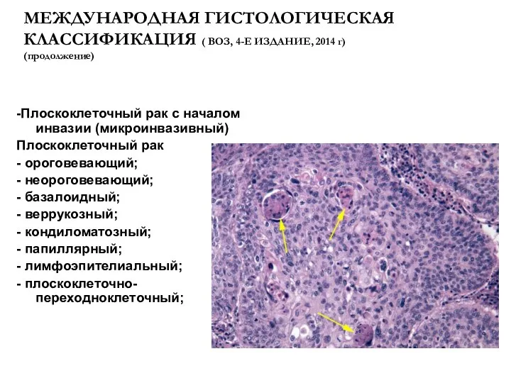 МЕЖДУНАРОДНАЯ ГИСТОЛОГИЧЕСКАЯ КЛАССИФИКАЦИЯ ( ВОЗ, 4-Е ИЗДАНИЕ, 2014 г) (продолжение) -Плоскоклеточный рак