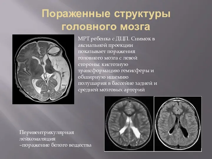 Пораженные структуры головного мозга МРТ ребенка с ДЦП. Снимок в аксиальной проекции