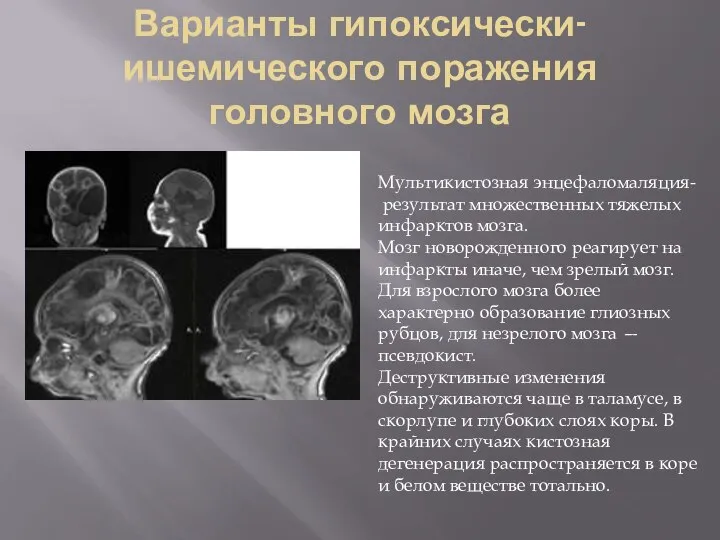 Варианты гипоксически-ишемического поражения головного мозга Мультикистозная энцефаломаляция- результат множественных тяжелых инфарктов мозга.