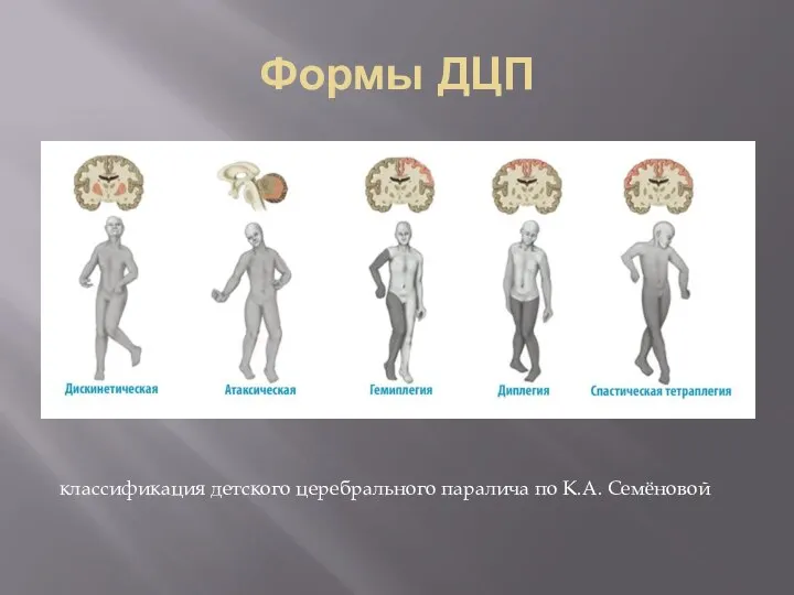 Формы ДЦП классификация детского церебрального паралича по К.А. Семёновой