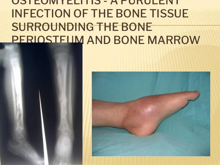 OSTEOMYELITIS - A PURULENT INFECTION OF THE BONE TISSUE SURROUNDING THE BONE PERIOSTEUM AND BONE MARROW