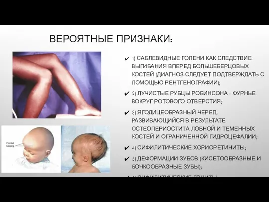 ВЕРОЯТНЫЕ ПРИЗНАКИ: 1) САБЛЕВИДНЫЕ ГОЛЕНИ КАК СЛЕДСТВИЕ ВЫГИБАНИЯ ВПЕРЕД БОЛЬШЕБЕРЦОВЫХ КОСТЕЙ (ДИАГНОЗ