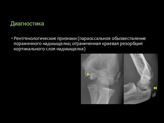 Диагностика Рентгенологические признаки (параоссальное обызвествление пораженного надмыщелка; ограниченная краевая резорбция кортикального слоя надмыщелка)