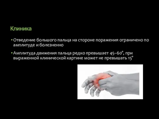 Клиника Отведение большого пальца на стороне поражения ограничено по амплитуде и болезненно