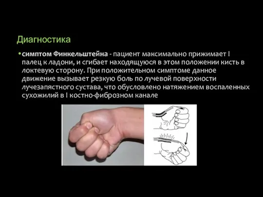 Диагностика симптом Финкельштейна - пациент максимально прижимает I палец к ладони, и