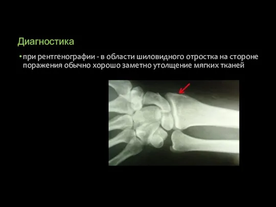 Диагностика при рентгенографии - в области шиловидного отростка на стороне поражения обычно