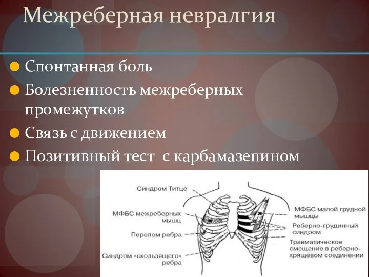 Межреберная невралгия Спонтанная боль Болезненность межреберных промежутков Связь с движением Позитивный тест с карбамазепином