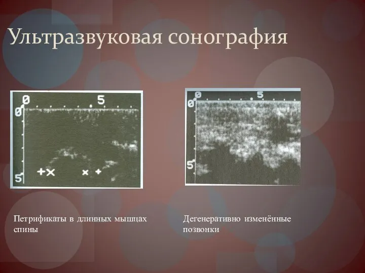 Ультразвуковая сонография Петрификаты в длинных мышцах спины Дегенеративно изменённые позвонки