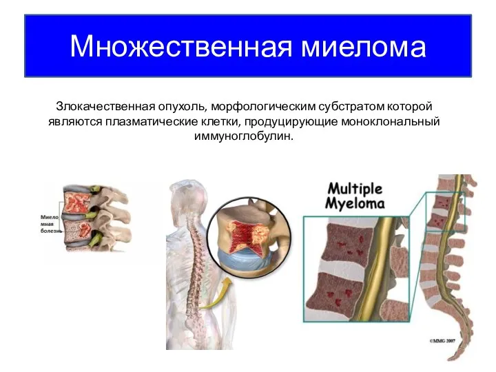 Множественная миелома Злокачественная опухоль, морфологическим субстратом которой являются плазматические клетки, продуцирующие моноклональный иммуноглобулин.