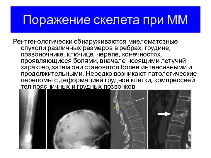 Поражение скелета при ММ Рентгенологически обнаруживаются миеломатозные опухоли различных размеров в ребрах,