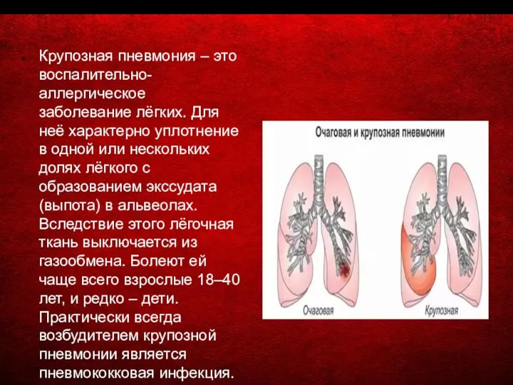 Крупозная пневмония – это воспалительно-аллергическое заболевание лёгких. Для неё характерно уплотнение в