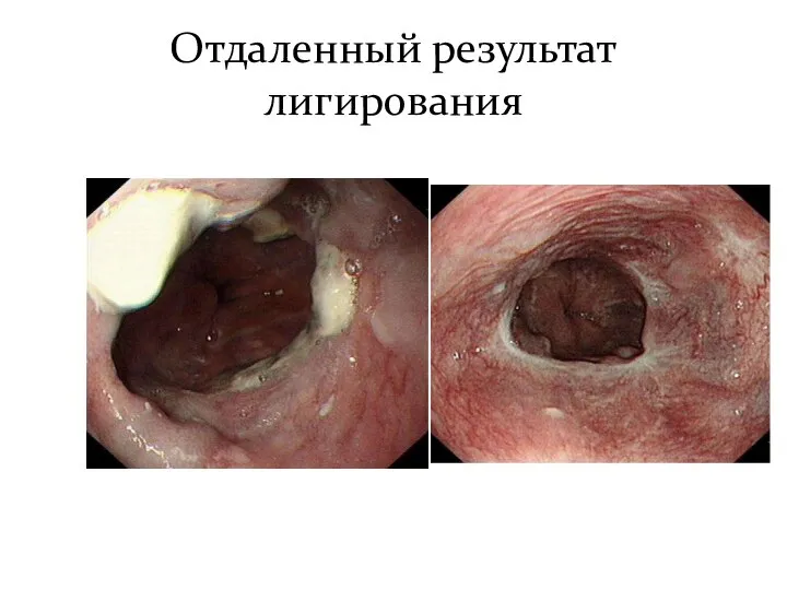 Отдаленный результат лигирования