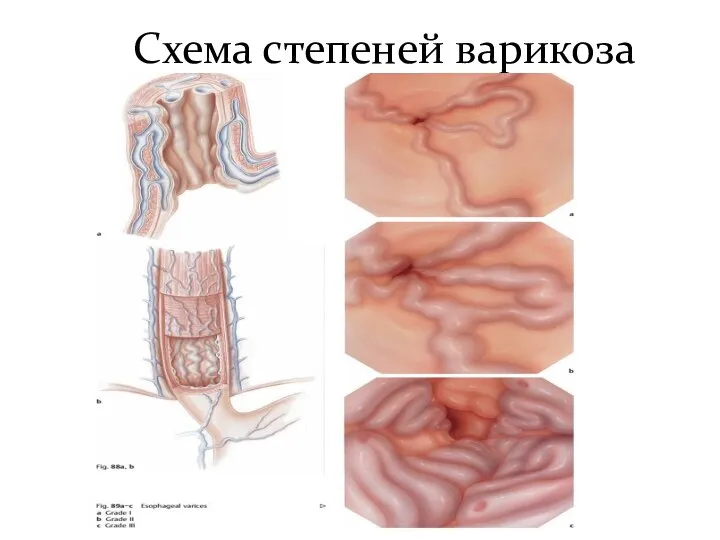 Схема степеней варикоза