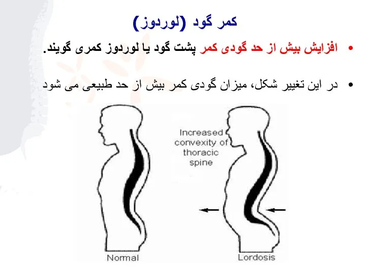 افزایش بیش از حد گودی کمر پشت گود یا لوردوز کمری گویند.