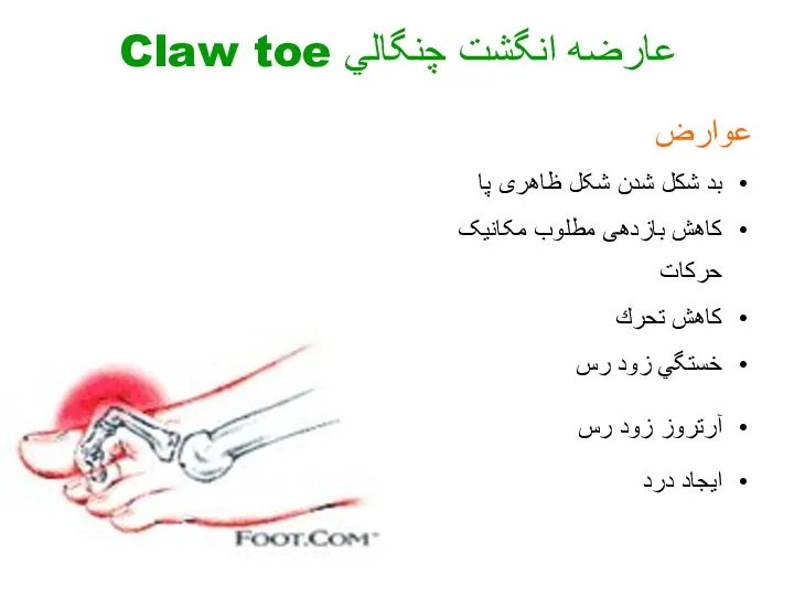 عوارض بد شكل شدن شکل ظاهری پا کاهش بازدهی مطلوب مکانیک حرکات