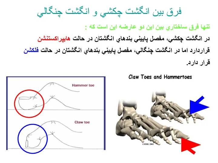 فرق بين انگشت چكشي و انگشت چنگالي تنها فرق ساختاري بين اين