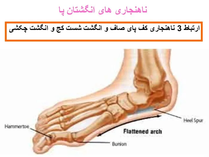 ارتباط 3 ناهنجاری کف پای صاف و انگشت شست کج و انگشت