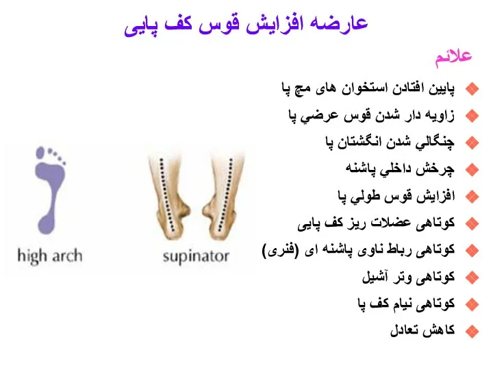 علائم پایین افتادن استخوان های مچ پا زاويه دار شدن قوس عرضي