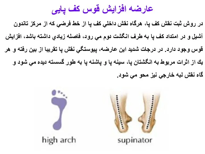 عارضه افزایش قوس کف پایی در روش ثبت نقش كف پا، هرگاه