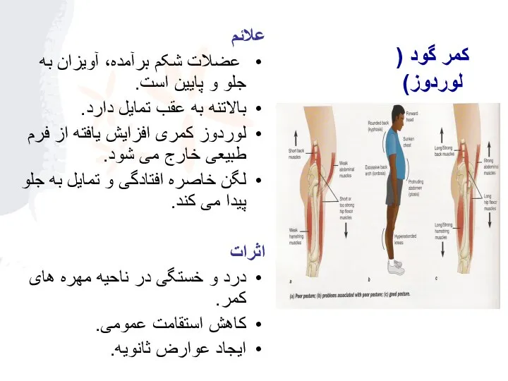 علائم عضلات شکم برآمده، آویزان به جلو و پایین است. بالاتنه به