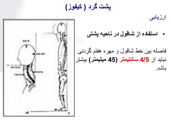 ارزیابی استفاده از شاقول در ناحیه پشتی فاصله بین خط شاقول و