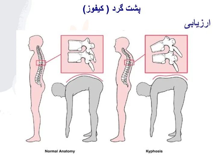 ارزیابی پشت گرد ( کیفوز)