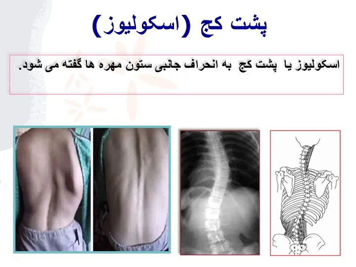 پشت کج (اسکوليوز) اسکوليوز یا پشت کج به انحراف جانبی ستون مهره ها گفته می شود.