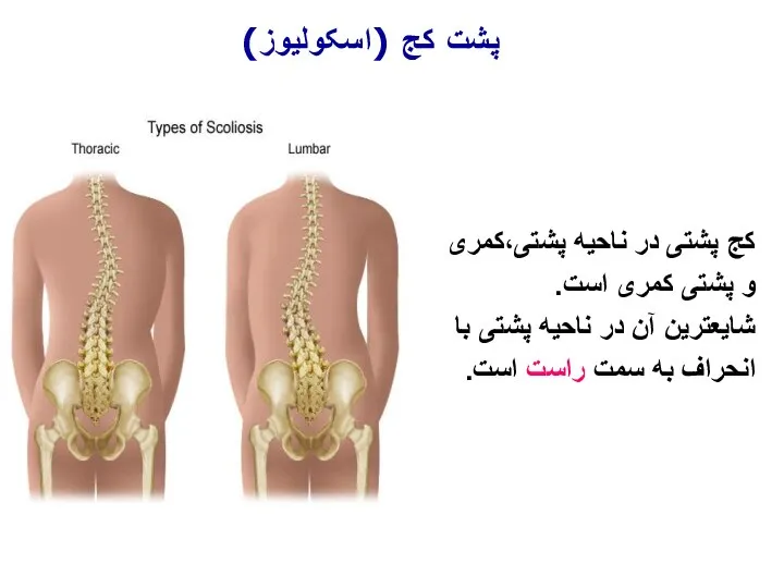 کج پشتی در ناحیه پشتی،کمری و پشتی کمری است. شایعترین آن در