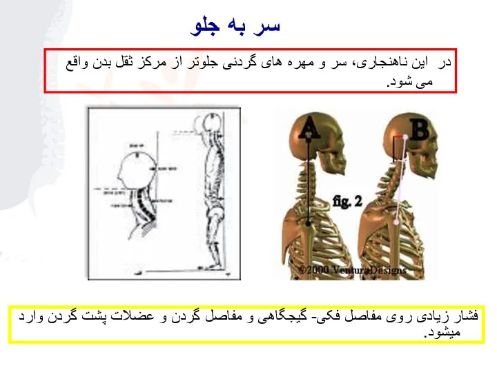 در اين ناهنجاری، سر و مهره های گردنی جلوتر از مرکز ثقل