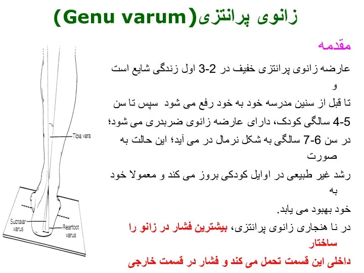 مقدمه عارضه زانوی پرانتزی خفیف در 2-3 اول زندگی شایع است و