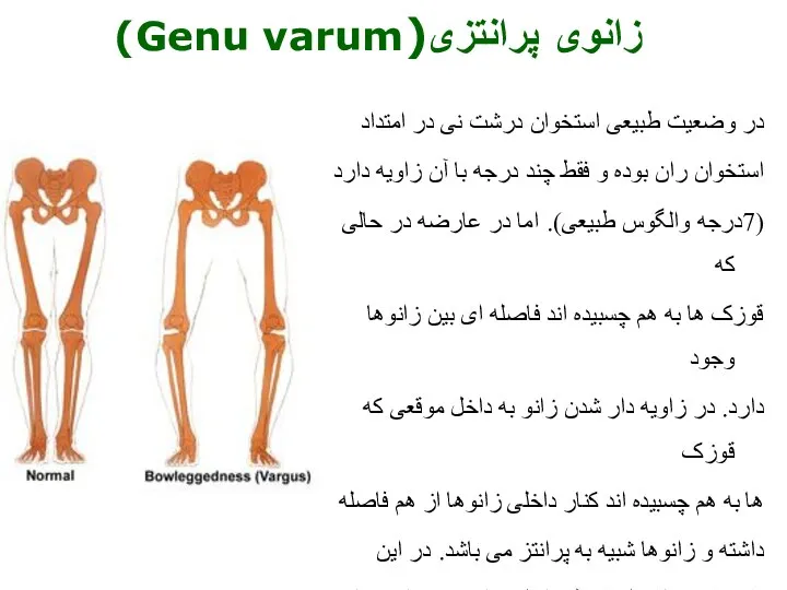 در وضعیت طبیعی استخوان درشت نی در امتداد استخوان ران بوده و